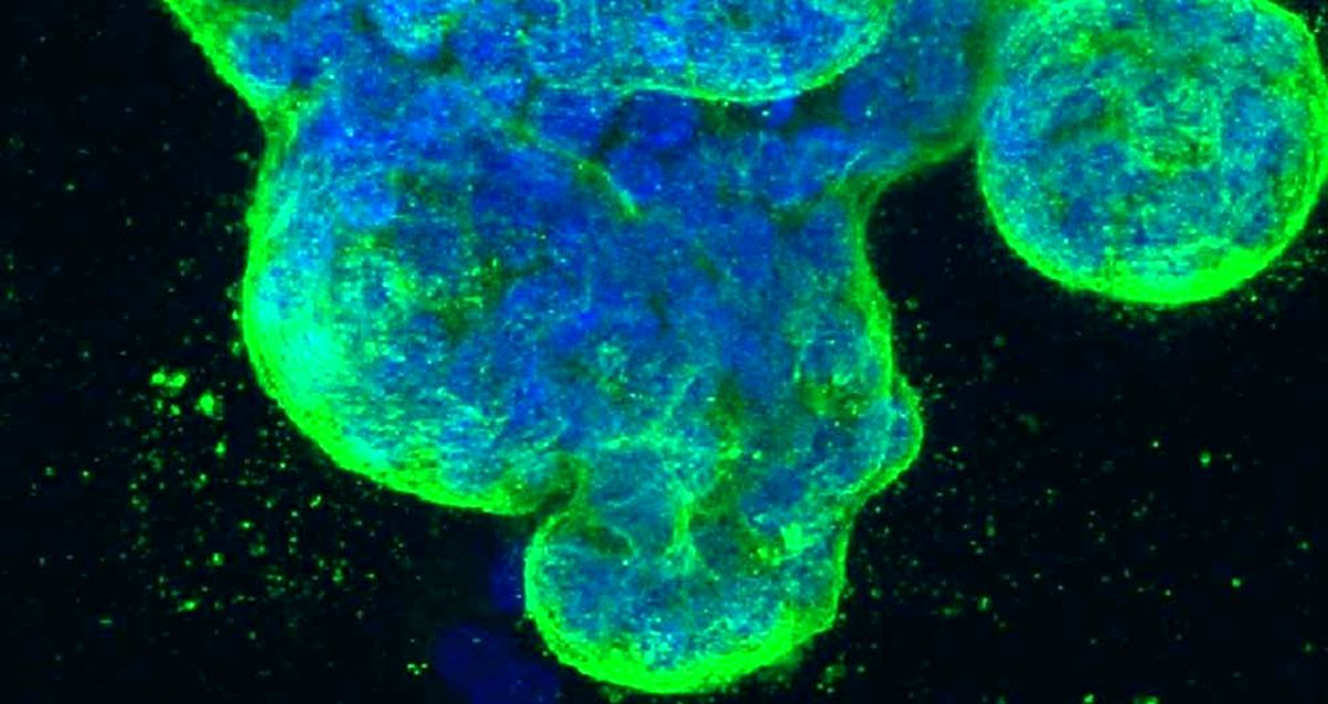 اسید و نور؛ قاتل جدید سلول های سرطانی